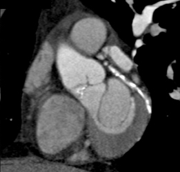 Diseased LAD??? - CTisus CT Scan