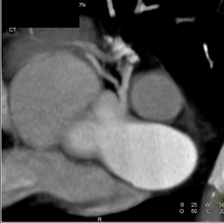 Stenosis in Origin of Circumflex - CTisus CT Scan