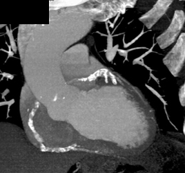 Calcified Plaque Through Multiple Vessels - CTisus CT Scan