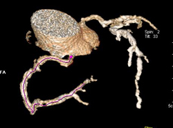 RCA Plaque and Stenosis - CTisus CT Scan