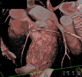 Normal LAD and Circumflex Artery (CX) - CTisus CT Scan