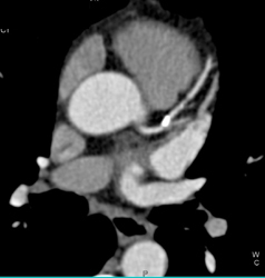 LAD Plaque and Stenosis - CTisus CT Scan