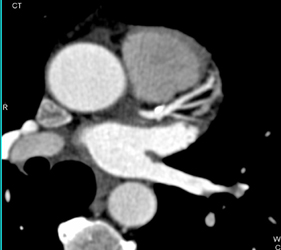 Trifurcation Vessels - CTisus CT Scan