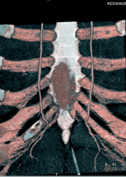 Internal Mammary Artery - CTisus CT Scan