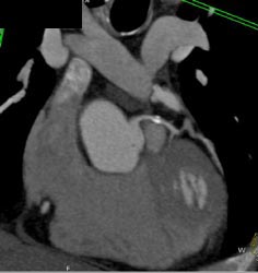 LAD Plaque Without Significant Stenosis - CTisus CT Scan