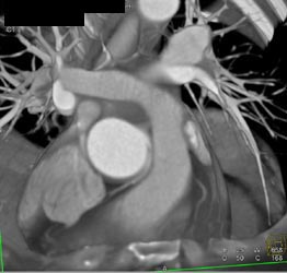 RCA Off of Left Cusp - CTisus CT Scan