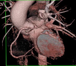 Left Main Off Right Coronary Artery - CTisus CT Scan