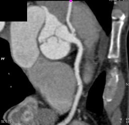 Left Main Off Right Coronary Artery - CTisus CT Scan