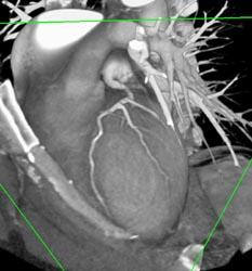 Left Main Off Right Coronary Artery - CTisus CT Scan