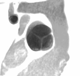 Minimal Thickening of Aortic Valve - CTisus CT Scan