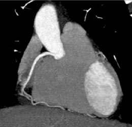 Normal RCA - CTisus CT Scan