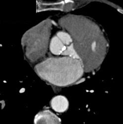 Calcified Aortic Valve - CTisus CT Scan