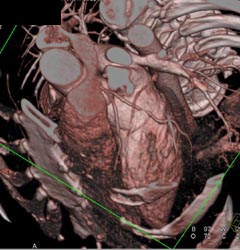 Normal LAD - CTisus CT Scan