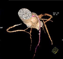 Minimal LAD Disease - CTisus CT Scan