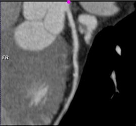 Minimal LAD Disease - CTisus CT Scan