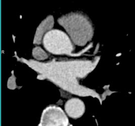 Minimal LAD Disease - CTisus CT Scan