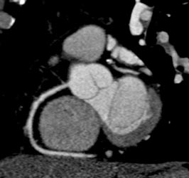 Normal RCA - CTisus CT Scan