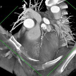 Plaque in LAD - CTisus CT Scan