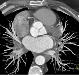 Multiple Visualizations of the RCA With Different Renderings - CTisus CT Scan