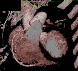 Multiple Calcified RCA Plaques - CTisus CT Scan