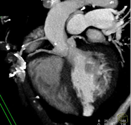 2 Right Coronary Arteries With One High Above Sinus - CTisus CT Scan