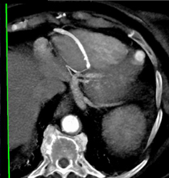 Plaque in RCA - CTisus CT Scan