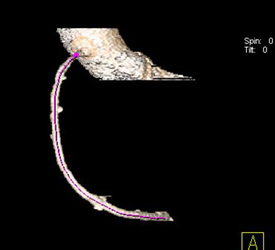 Minimal Disease of the RCA - CTisus CT Scan