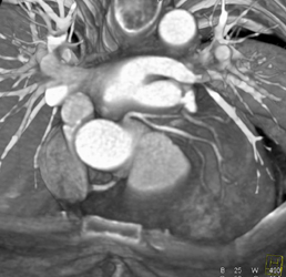 Normal Left Main and Branching Into LAD and Circumflex - CTisus CT Scan