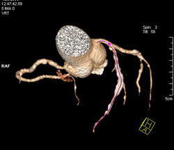 Plaque in LAD - CTisus CT Scan