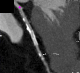 Plaque With Stent in the RCA - CTisus CT Scan