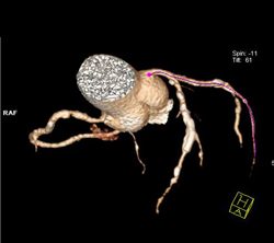 Diseased Circumflex Artery - CTisus CT Scan