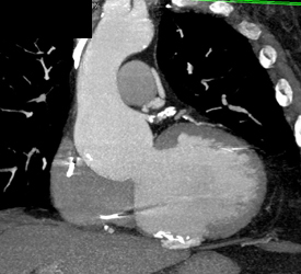 Diseased Root and LAD - CTisus CT Scan