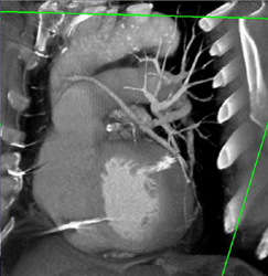 Bypass Grafts - CTisus CT Scan