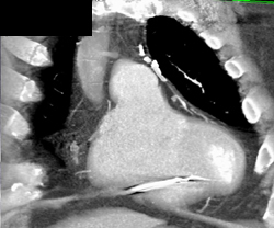 Left Internal Mammary Artery (LIMA) Graft and Saphenous Grafts - CTisus CT Scan