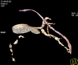 Patent Bypass Graft - CTisus CT Scan