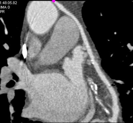 Patent Bypass Graft - CTisus CT Scan