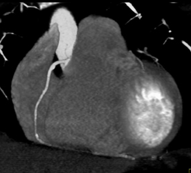 Plaque in RCA - CTisus CT Scan