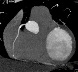 Plaque in RCA - CTisus CT Scan