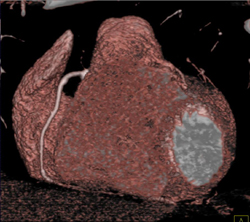 Plaque in RCA - CTisus CT Scan