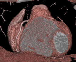 Plaque in RCA - CTisus CT Scan