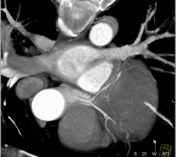 Plaque in RCA - CTisus CT Scan