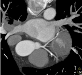 Multiple Vessel Disease With Calcified Plaques - CTisus CT Scan