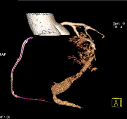 Minimal Disease in RCA - CTisus CT Scan