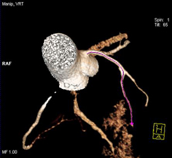 Diseased LAD - CTisus CT Scan