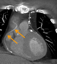 Bypass Grafts and Left Internal Mammary Artery (LIMA) - CTisus CT Scan