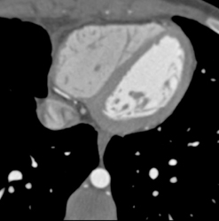 Occluded Right Internal Mammary Artery (RIMA) Graft in Child With RCA Arising Off Left Cusp - CTisus CT Scan