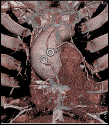 Bypass Grafts and New Type-a Dissection - CTisus CT Scan