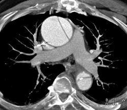 Type-a Dissection - CTisus CT Scan