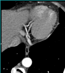 Right Dominant Circulation - CTisus CT Scan