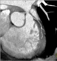 Soft Plaque LAD With Stenosis - CTisus CT Scan